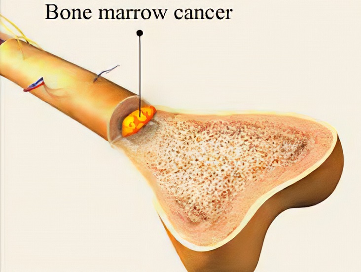 Bone Marrow Cancer Treatment