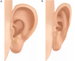 Ear Surgery (Pinnaplasty), Singapore