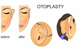 Otoplasty Ear Surgery