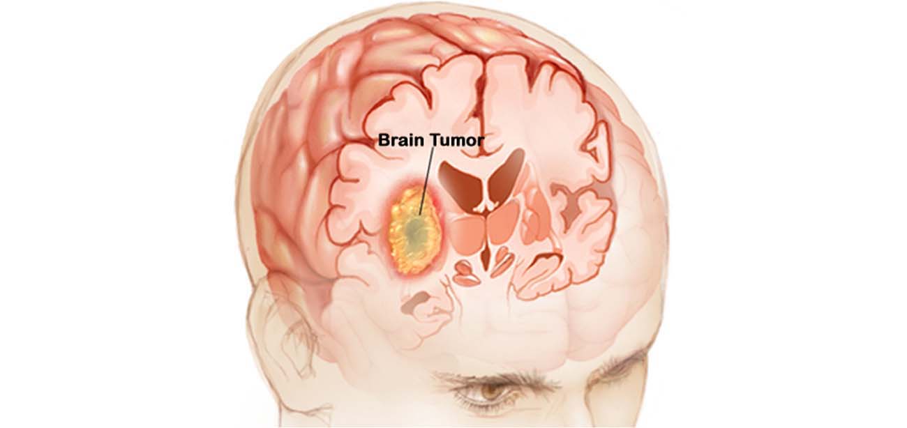 Brain Tumor Surgery, India