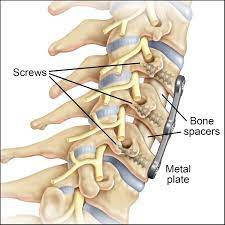 Cervical Anterior Spinal Fusion Surgery