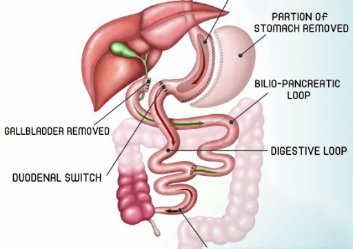 Duodenal Switch, Thailand