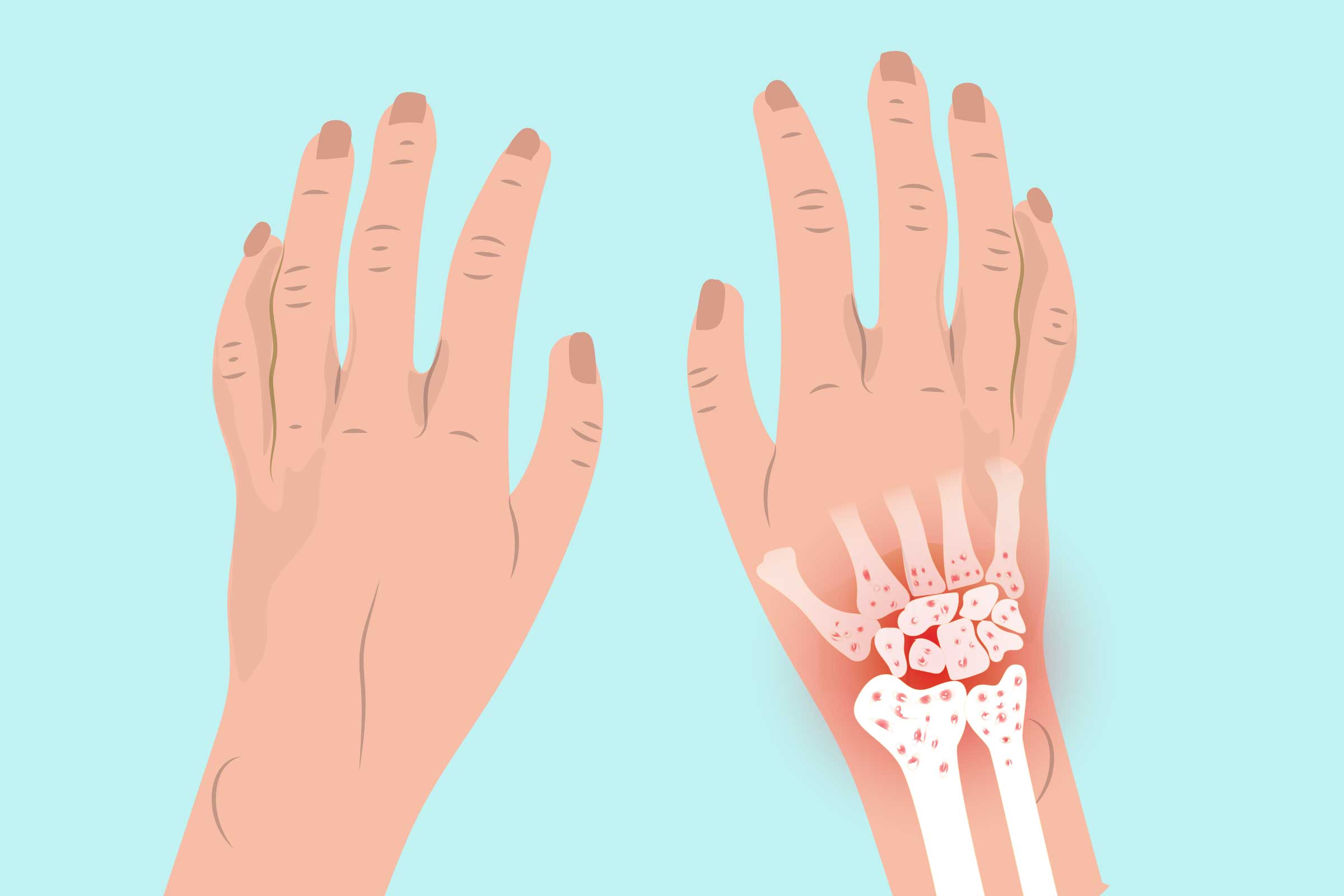 Wrist Joint Replacement (Wrist Arthroplasty)