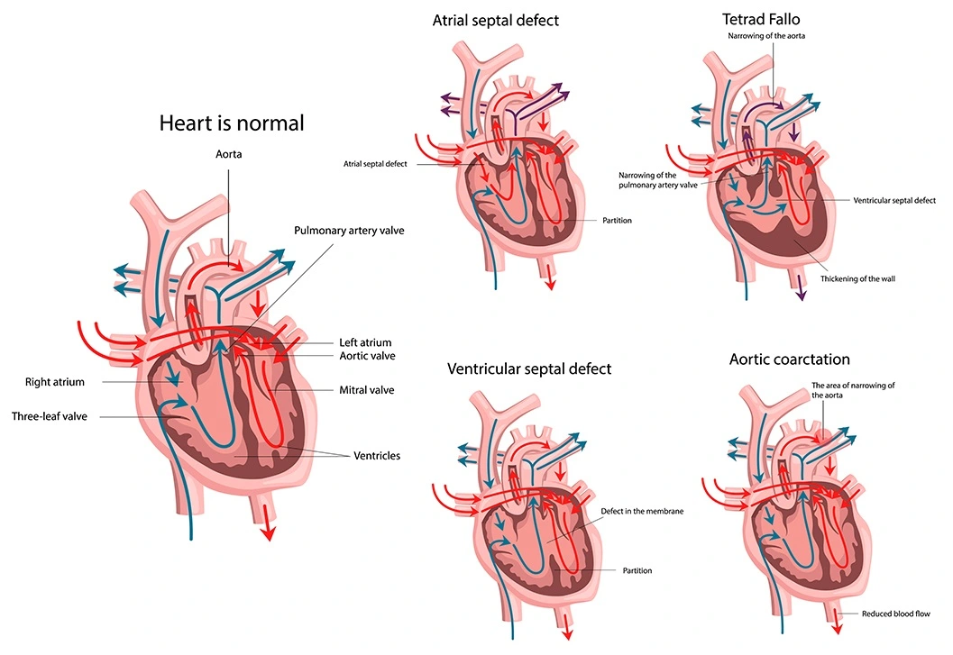 Congenital Heart disease treatment