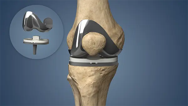 Total Knee Replacement UL, Turkey