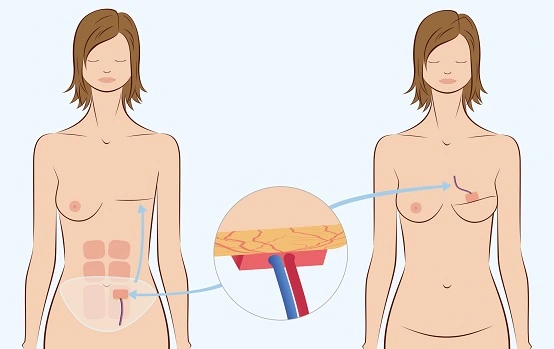 Breast reconstruction surgery