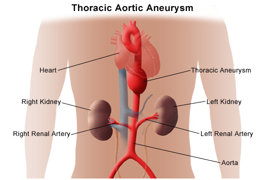 Thoracic Aortic Aneurysm Treatment