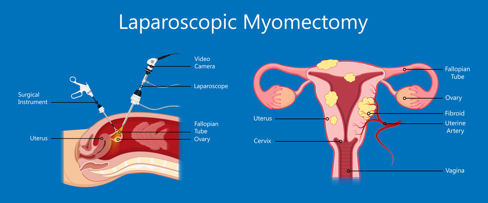 Laparoscopic Myomectomy Surgery, Turkey