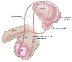 Vasectomy Reversal
