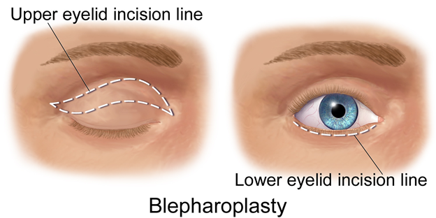 Blepharoplasty (Eyelids), Singapore