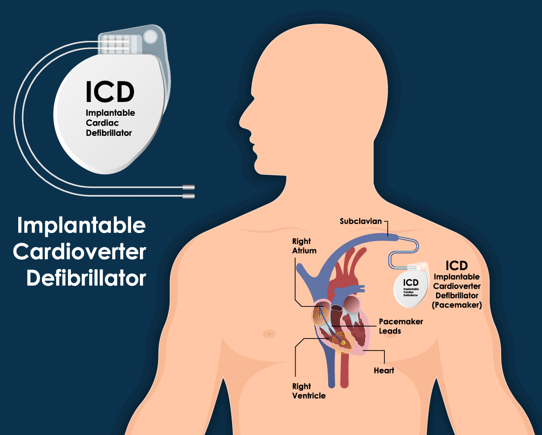 ICD