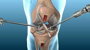 Revision ACL Reconstruction Surgery, Canada
