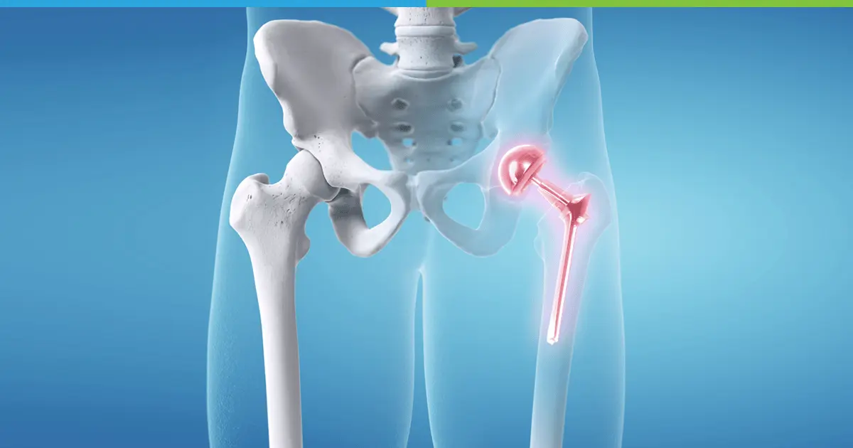 Total Hip Replacement BL, Turkey