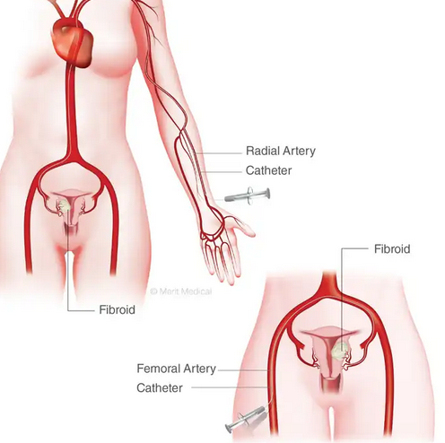 Uterine Fibroid Embolization (UFE)