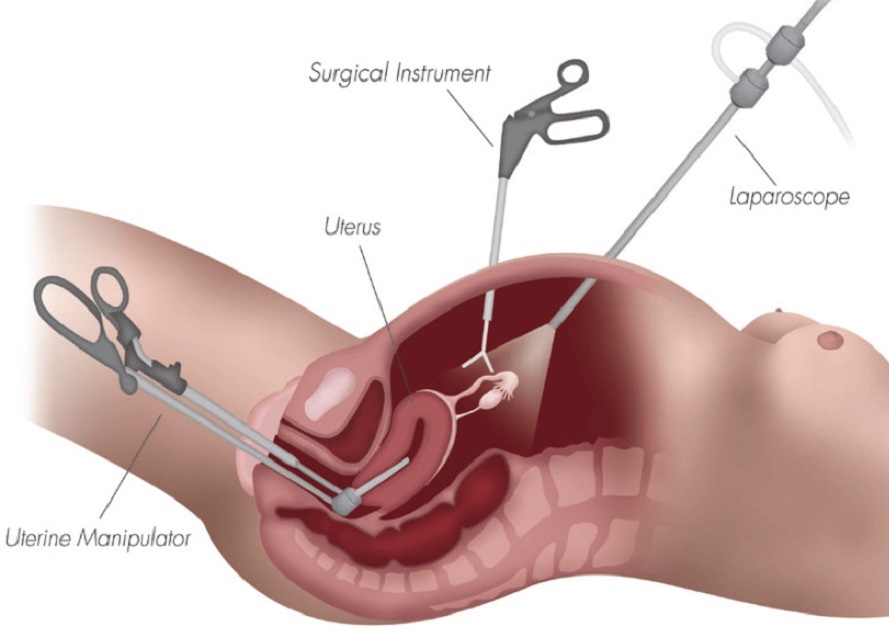 Vaginal Hysterectomy Surgery, Turkey
