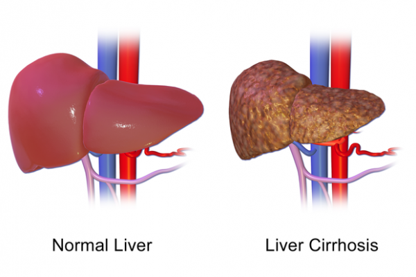 Liver Cirrhosis Treatment, Turkey