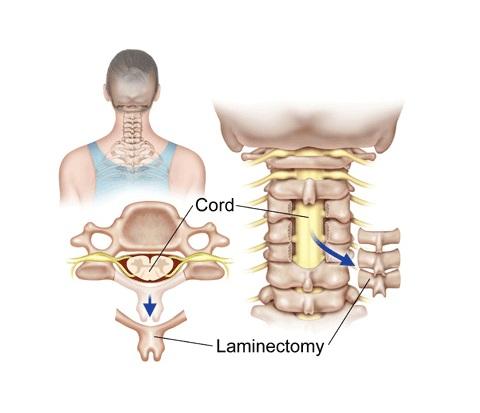 Laminectomy & Discectomy, Iran