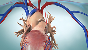 CABG