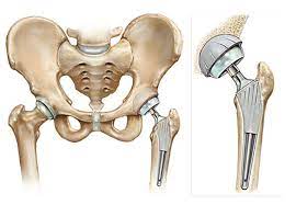 Hip Reconstruction Surgery, Turkey
