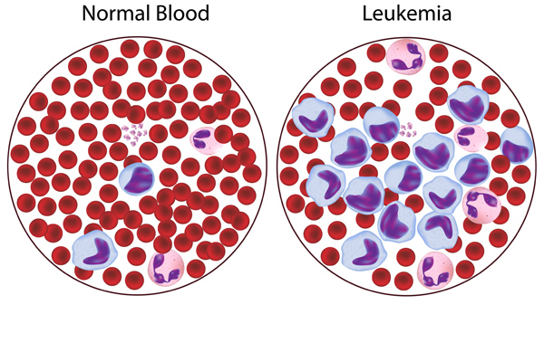 Acute Lymphocytic Leukemia - ALL in Adults, India