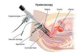 Hysterectomy Myomectomy