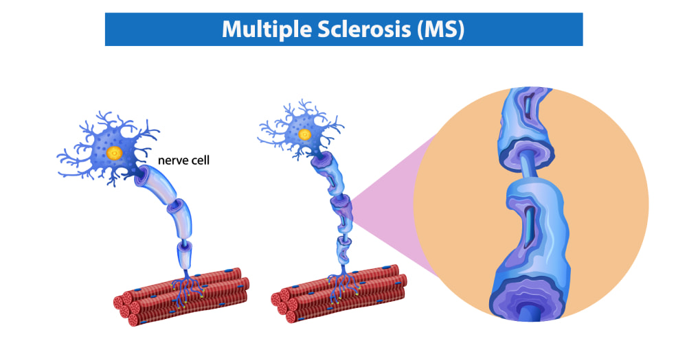 Multiple Sclerosis Treatment, Turkey