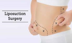 Liposuction 3-5 sides, India