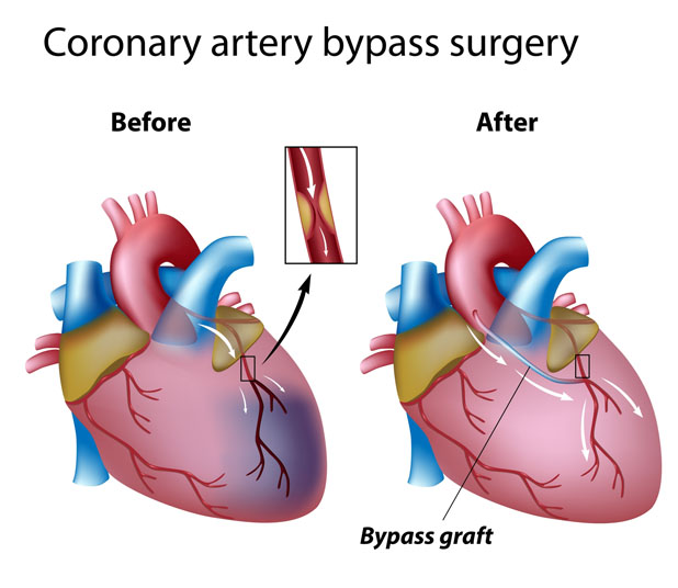 CABG