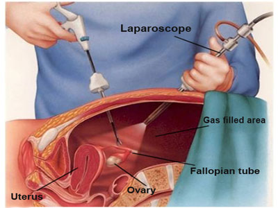 Ovary Surgery, Canada