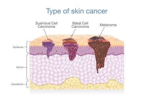 Skin Cancer Treatment, Thailand