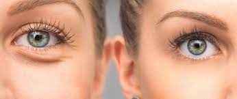 Blepharoplasty 4 Eyelid, India
