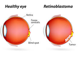 Retinoblastoma (RB) Treatment