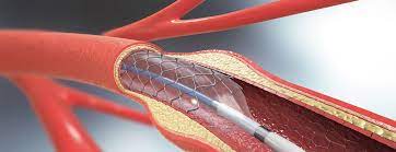 Cardiac Stent Implantation