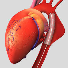 TEVAR (Thoracic endovascular aortic repair)