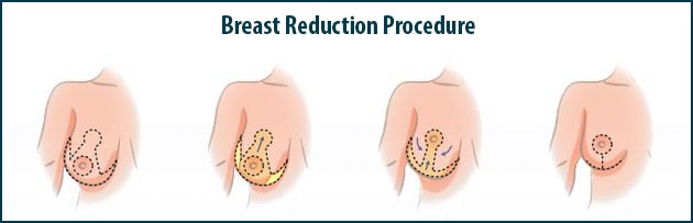 Breast Reduction, Iran