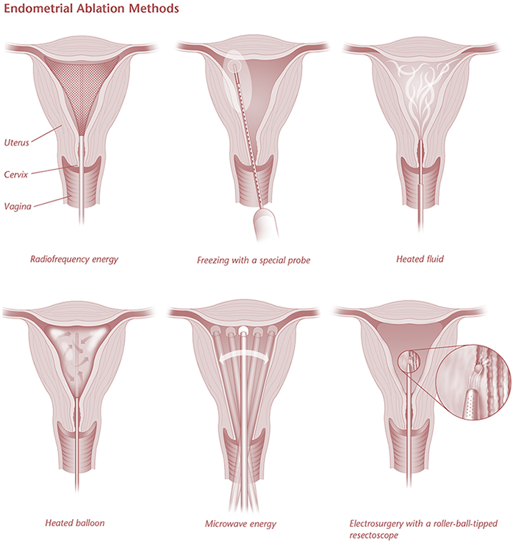 Microwave Endometrial Ablation