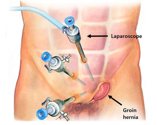Laparoscopic Hernia Repair, India