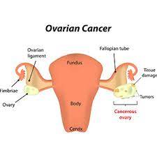 Ovarian Cancer Treatment, Singapore