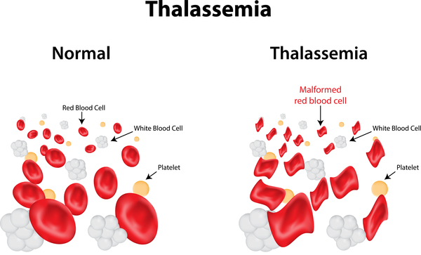 Thalassemia Treatment, Turkey