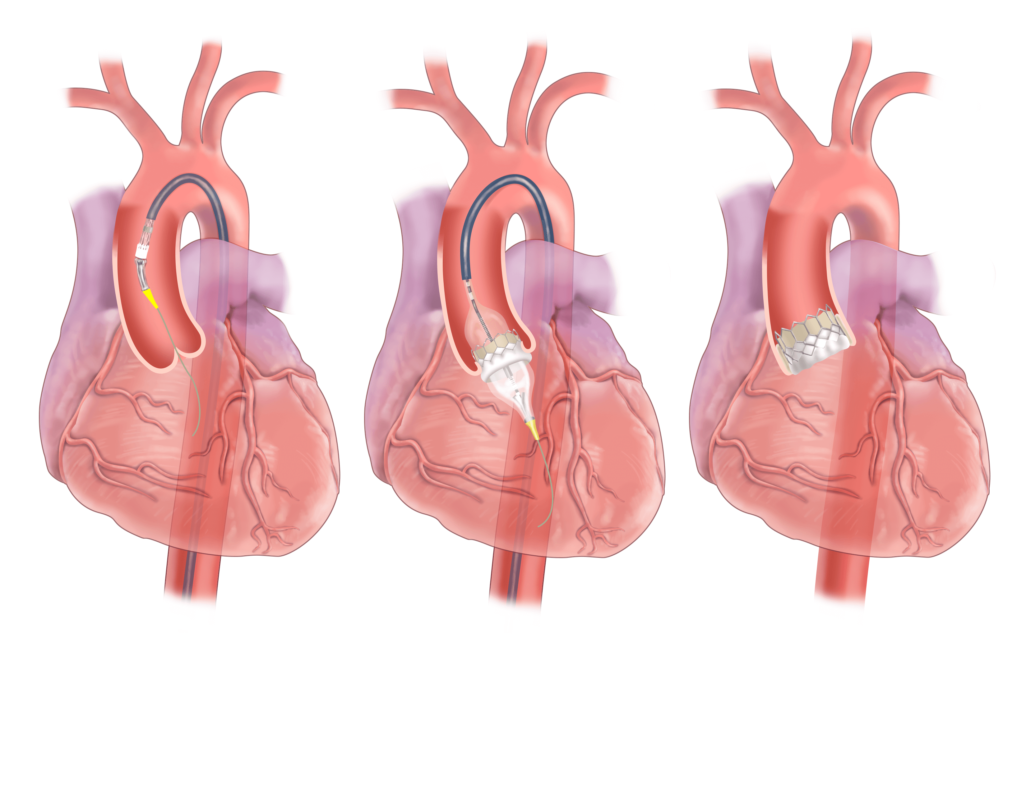 Transcatheter aortic valve implantation