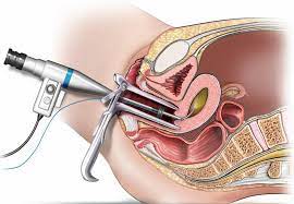 Laparoscopic Hysterectomy, Canada