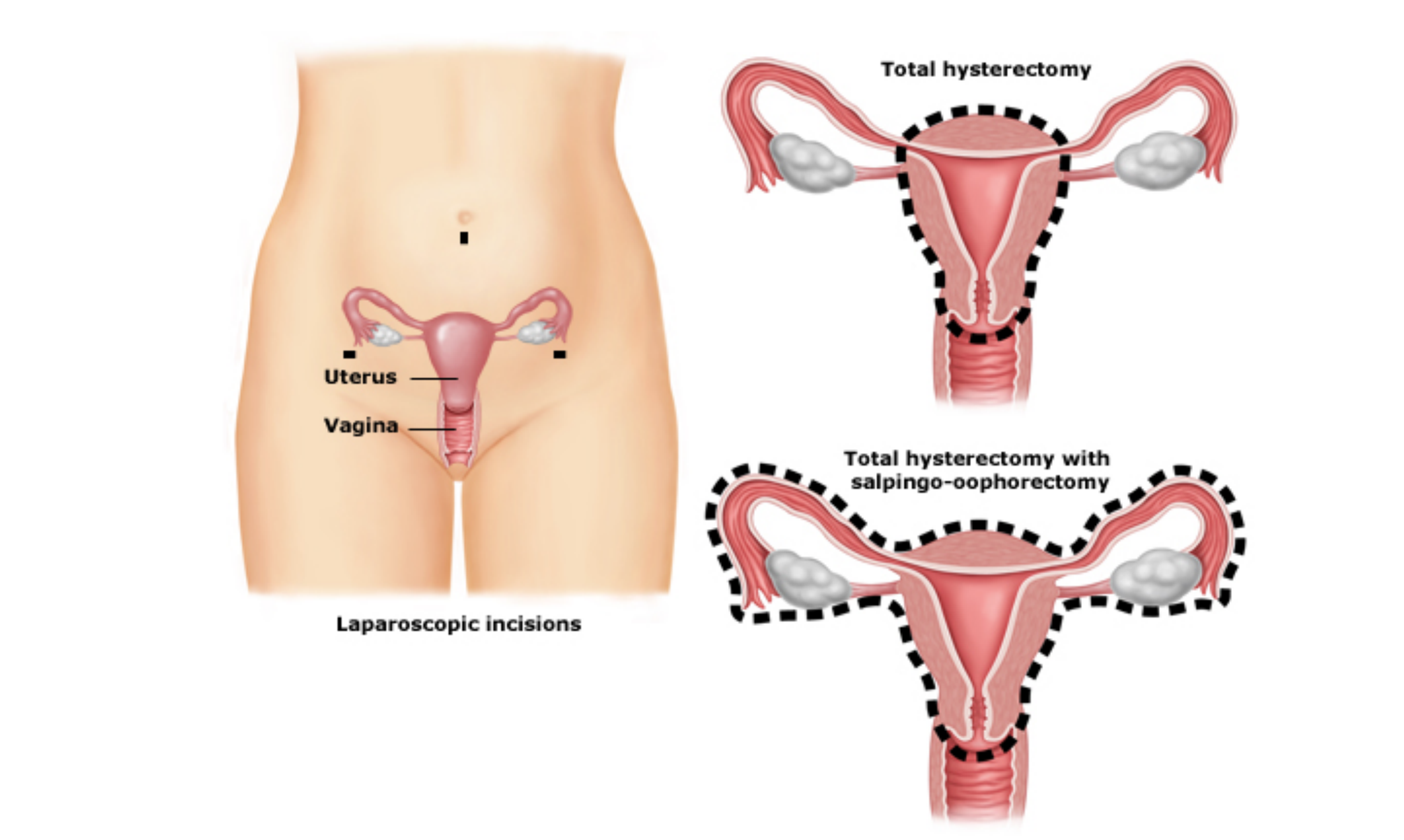 Laparoscopic Abdominal Hysterectomy