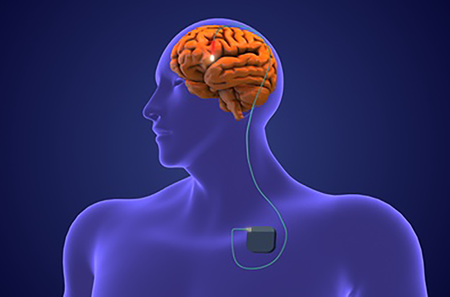 Deep Brain Stimulation - Non-Rechargeable Implant