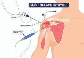 Diagnostic shoulder Arthroscopy