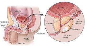 Prostate Cancer Treatment, Thailand