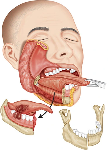 Radical maxillectomy with mandibulectomy
