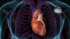 Biventricular Pacemaker Surgery