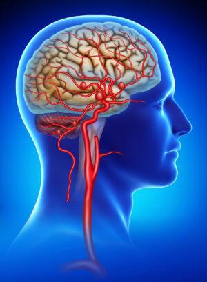 Angioplasty of the brain arteries