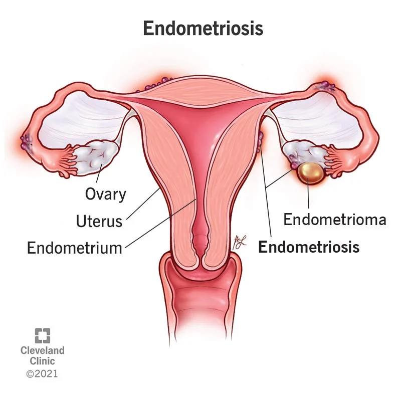 Endometriosis Treatment, Turkey