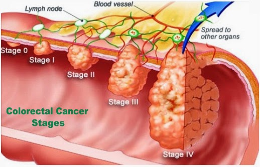 Colorectal Cancer Treatment (Ist Stage), Canada